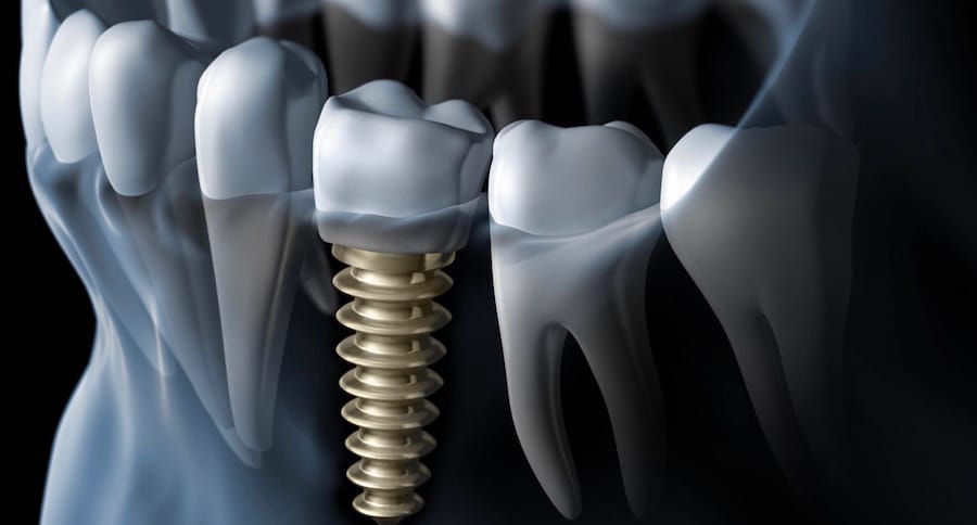 3D illustration showing dental implant placed in the jawbone to replace a missing tooth