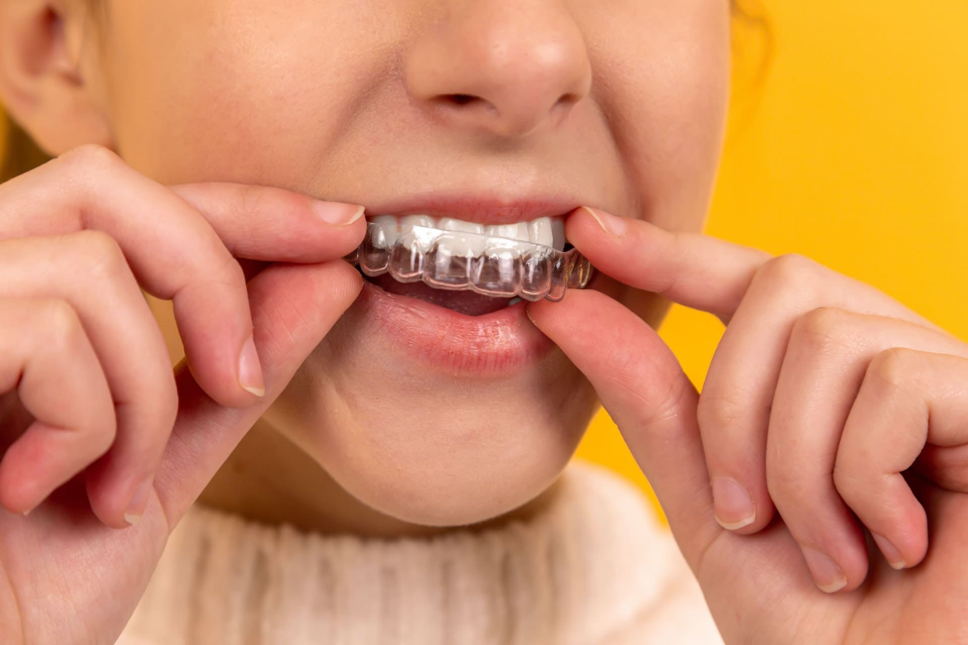 Close-up of a person placing clear Invisalign aligners onto crowded upper teeth during orthodontic treatment.